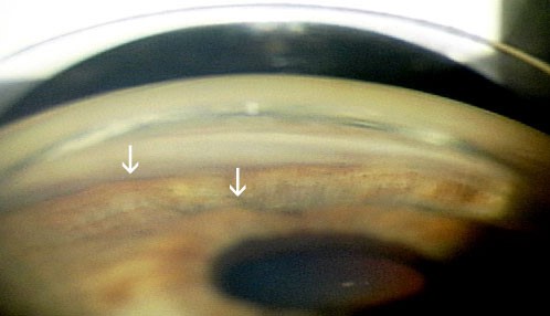 Appiattimento dell'iride e apertura dell'angolo irido-corneale dopo iridoplastica